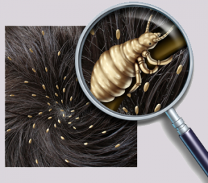 Pidocchi: Cosa cercare